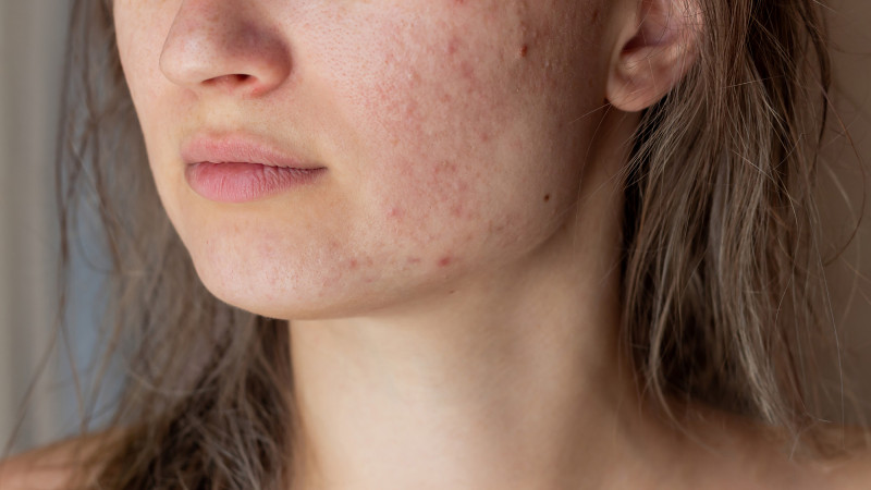 What is Acne?